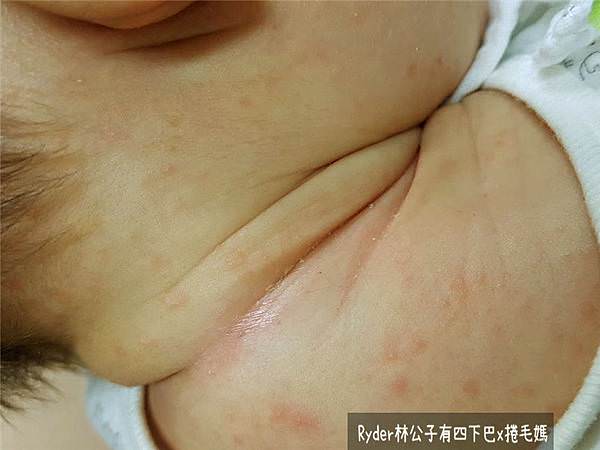 屁屁膏舒緩乳霜過敏肌desitin drhuang09.jpg